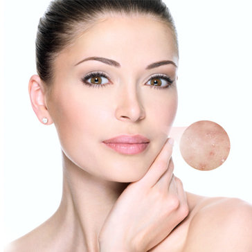 Trị Mụn Chuyên Sâu Tại Alice Spa