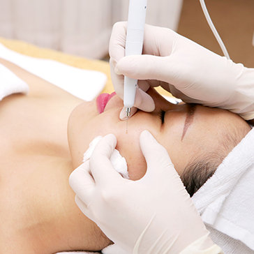 Xóa Mụn Ruồi, Xóa Mụn Thịt, Mụn Cóc Tại Thẩm Mỹ Viện LaVa