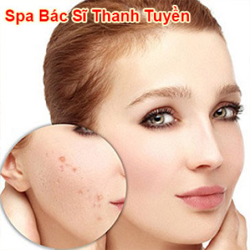 Quy Trình Sẹo Rỗ, Thâm Mụn, Nám, Se Khít Lỗ Chân Lông Bằng...