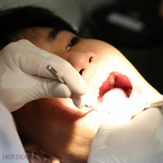 Răng Sứ Titan - Bảo Hành 05 Năm Tại Hệ Thống Nha Khoa Việt Nha