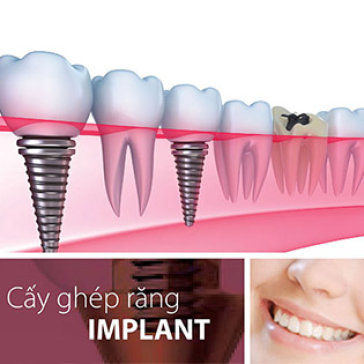 Cấy- Ghép Implant Đức, Mỹ, Pháp - Phương Pháp Trồng Răng Hiệu...