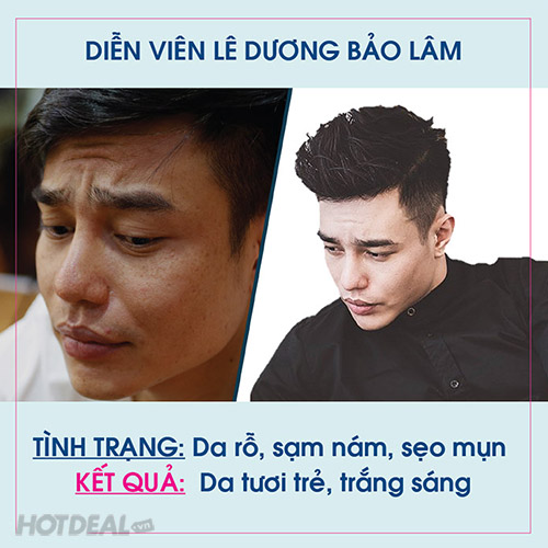 Điều trị sẹo rổ: Sẹo rổ có thể khiến bạn cảm thấy không tự tin. Nhưng đừng lo, chúng tôi có một giải pháp cho bạn. Hãy để chúng tôi chỉ bạn cách điều trị sẹo rổ một cách hiệu quả để giúp bạn tái tạo các tế bào mới và có được làn da mịn màng trở lại.