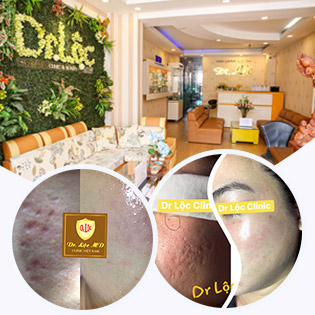Trọn Gói 03 Buổi Điều Trị Sẹo Rỗ Tặng Điều Trị Lỗ Chân Lông To/ Nám, Tàn Nhang, Đồi Mồi, Đốm Nâu Tại Viện Da Dr Lộc