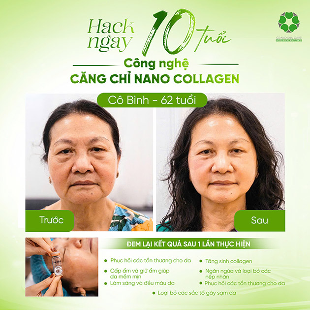 Grand Skin Care - Căng Chỉ Nano Collagen Trẻ 10 Tuổi - Hiệu Quả