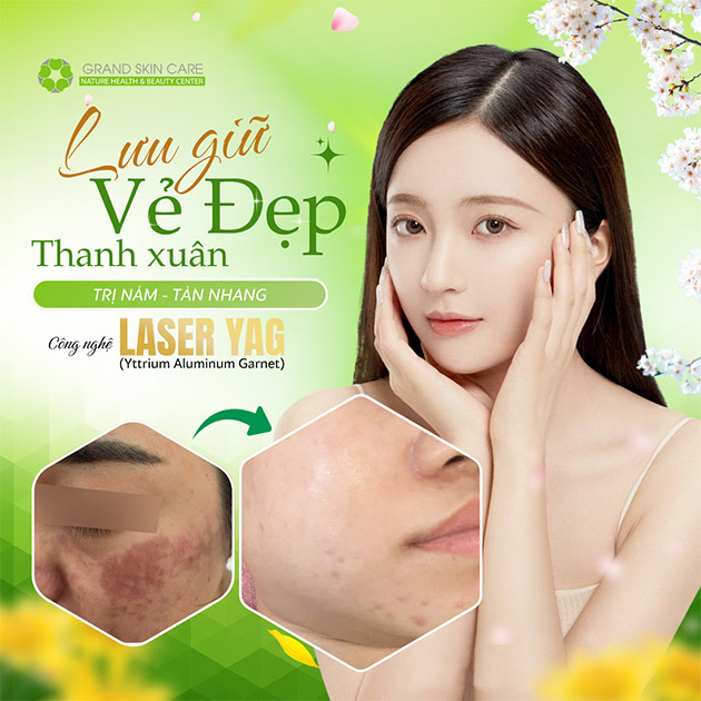 Grand Skin Care - Trị Nám, Tàn Nhang - Hiệu Quả Ngay Lần Đầu