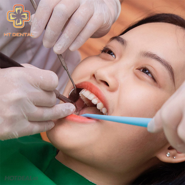 Tẩy Trắng Răng Công Nghệ Plasma Từ UK - Nha Khoa HT