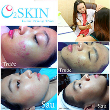 Chăm Sóc Da Mụn Đặc Trị Tại Phòng Khám Da Liễu O2 Skin