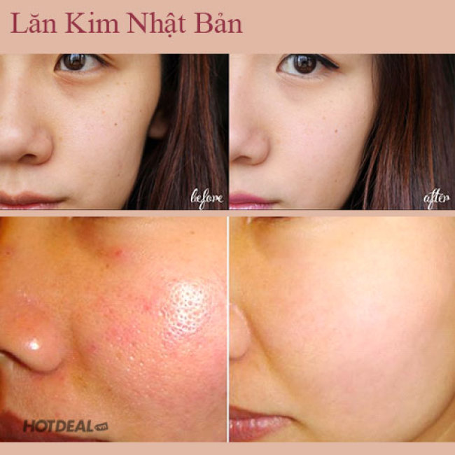 Điều Trị Lỗ Chân Lông To, Viêm Nang Lông, Viêm Tuyến Bã Nhờn